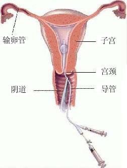 输卵管道堵塞怎么疏通(输卵管道堵塞怎么疏通最有效)