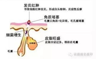 怎么定期疏通皮脂腺管道(怎么定期疏通皮脂腺管道的方法)