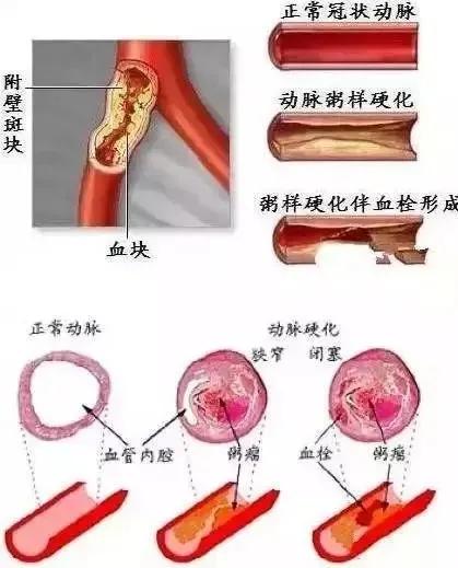 中医怎么疏通心血管道(中医怎么疏通心血管道堵塞)