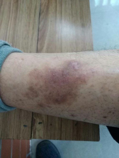 腿上长疙瘩怎么疏通管道(腿上疙瘩怎么去) 腿上长疙瘩怎么疏通管道(腿上疙瘩怎么去)