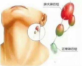 怎么疏通下巴淋巴管道(怎么疏通下巴淋巴管道堵塞)