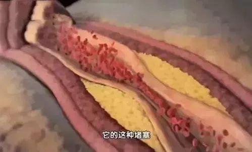 血管的管道堵塞怎么疏通(血管堵塞怎么办?教你一招,快速疏通)
