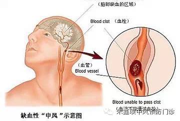 血栓怎么疏通主管道(血栓疏通技术多少钱)